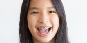 Ramai Balita Dipasangkan Kawat Gigi, Kapan Anak Boleh Pakai Behel?