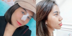Buka Perban Usai Operasi Plastik Hidung, Ini Potret Mayang Lucyana yang Dipuji Makin Cantik
