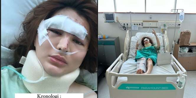 Potret Angela Lee yang Mengalami Kecelakaan hingga Harus Pasang Pen di Kaki