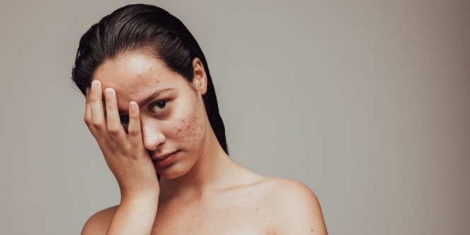 10 Rekomendasi Skincare untuk Kulit Berjerawat, Efektif Bikin Wajah Mulus dan Kembali Sehat