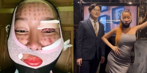 Gak Kapok-kapok, Lucinta Luna Pamer Wajah Bengkak Usai Oplas Anti Tua di Korea