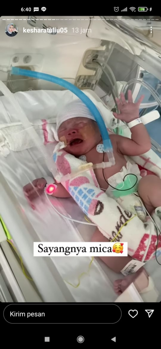Potret Baby Qwenzy, Anak Kehsa Ratuliu yang Pakai Alat Bantu Pernapasan karena Napas Terburu-buru
