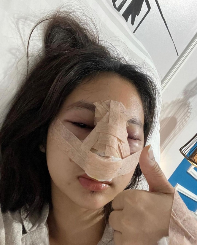 7 Potret Permesta Dhyaz Anak Farida Nurhan Usai Operasi Hidung, Wah Bengkak dan Penuh Perban Bikin Pangling