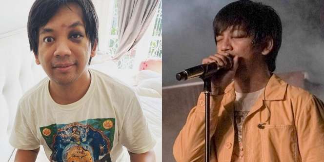 Kondisi Terbaru Ryan DMasiv Usai Alami Kecelakaan, Sudah Bisa Manggung Meski dengan Mata Lebam