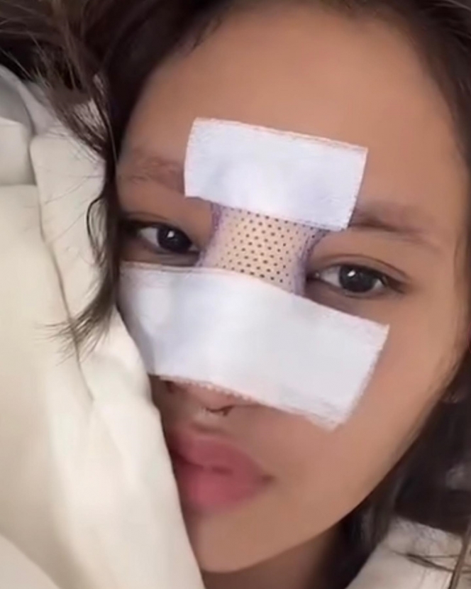 Dapat Kritikan Netizen, Ini 5 Potret Kondisi Terbaru Permesta Dhyaz Anak Farida Nurhan Usai Infeksi Implan Hidung