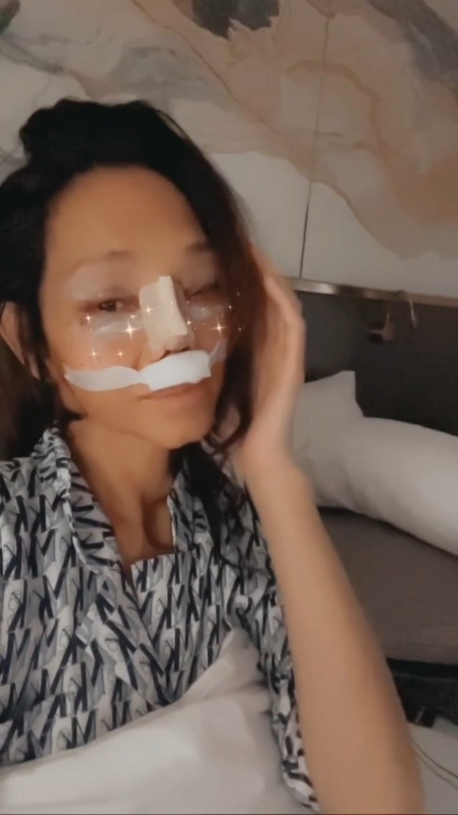 Bunda Corla Pamer Hasil Operasi Plastik di Bagian Hidung, Rekan-rekan Selebriti Puji Makin Cantik