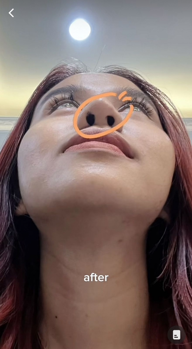 Potret Terbaru Mayang Lucyana Usai Operasi Hidung Kedua, Bentuk Cupingnya Curi Perhatian
