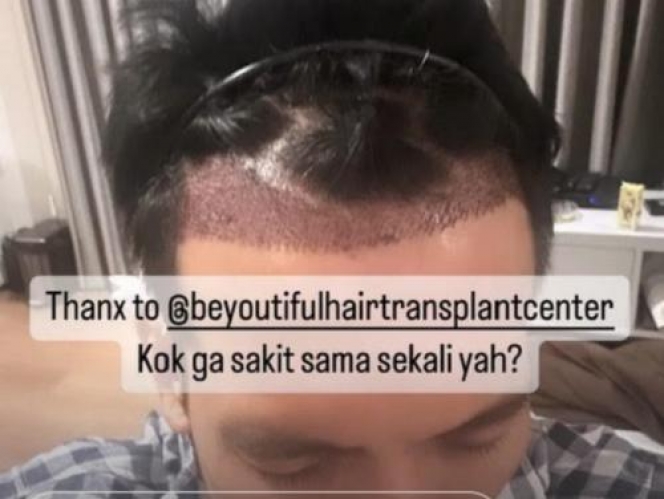 Sempat Pitak, Ini 10 Foto Desta yang Memutuskan untuk Tanam Rambut dan Brewok