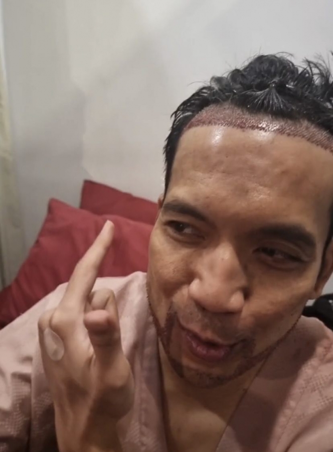 Sempat Pitak, Ini 10 Foto Desta yang Memutuskan untuk Tanam Rambut dan Brewok